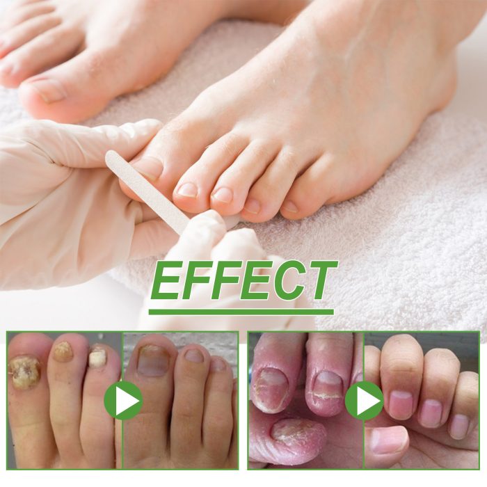 Best Nail Repair Roller Gray Thickening Nail Care Solution - Image 5