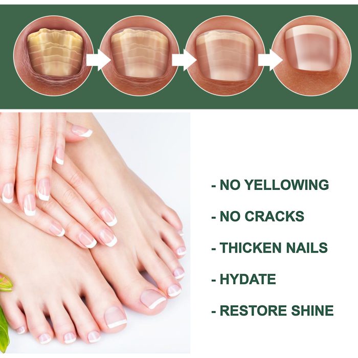 Foot Care Solution Onychomycosis Nail Care Solution - Image 3
