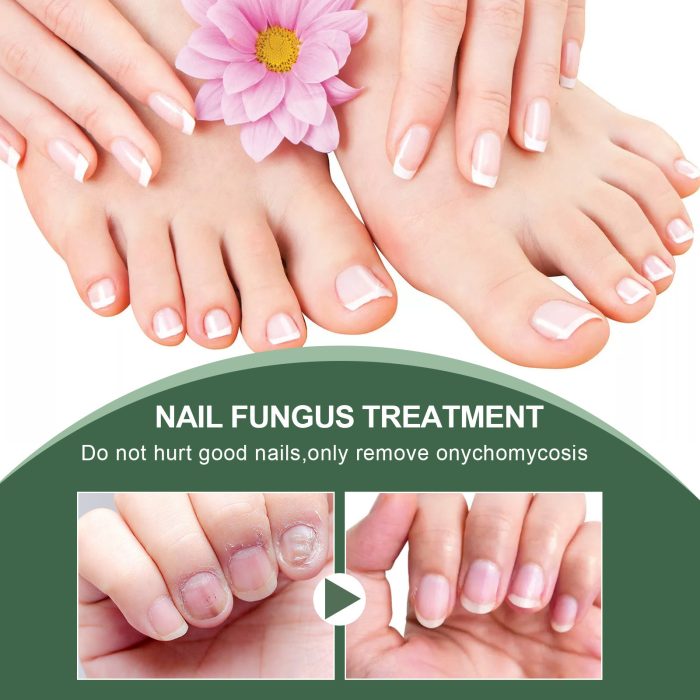 Foot Care Solution Onychomycosis Nail Care Solution - Image 2