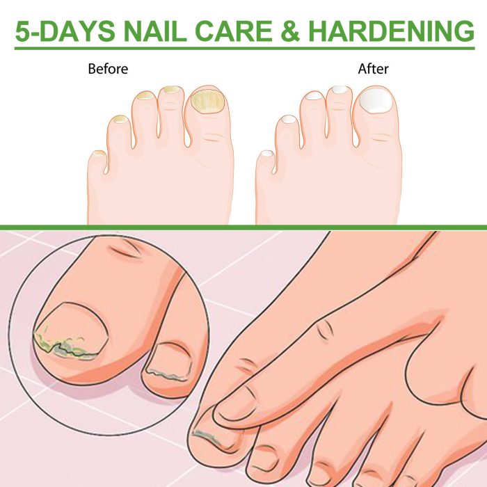 Best Nail Repair Roller Gray Thickening Nail Care Solution - Image 9