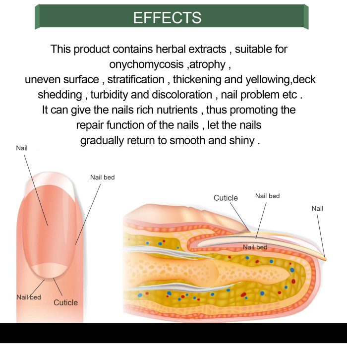 Foot Care Solution Onychomycosis Nail Care Solution - Image 6